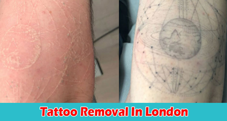 Complete Information Tattoo Removal In London