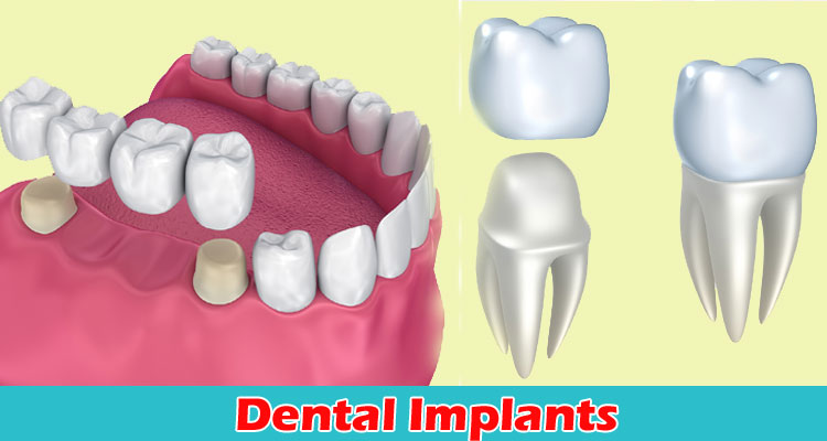 Latest News Dental Implants